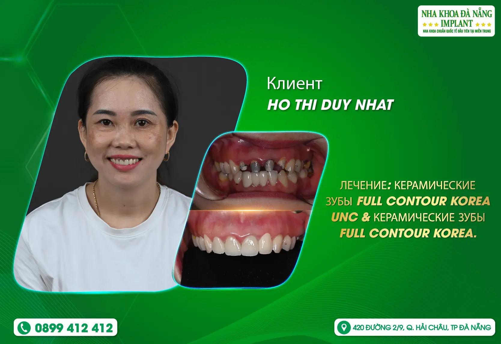 [Отзыв] Верните себе сияющую улыбку вместе с Da Nang Implant Dental Clinic