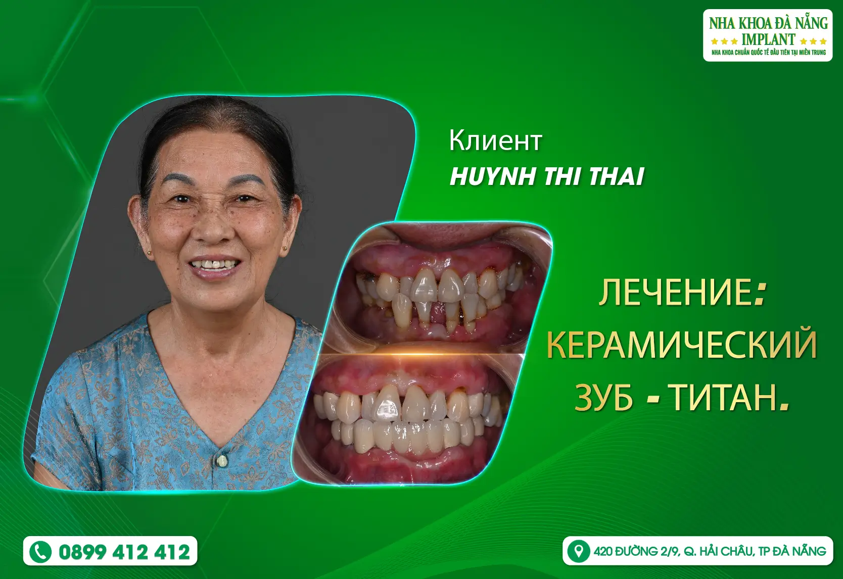 [Отзыв] Не недооцените важность ухода за зубами у пожилых людей.