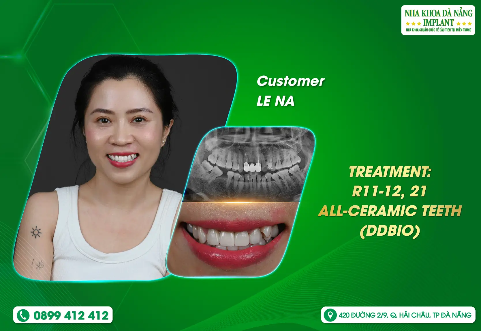 [Feedback] What makes customers feel secure when using services at Danang Implant Dental Clinic?