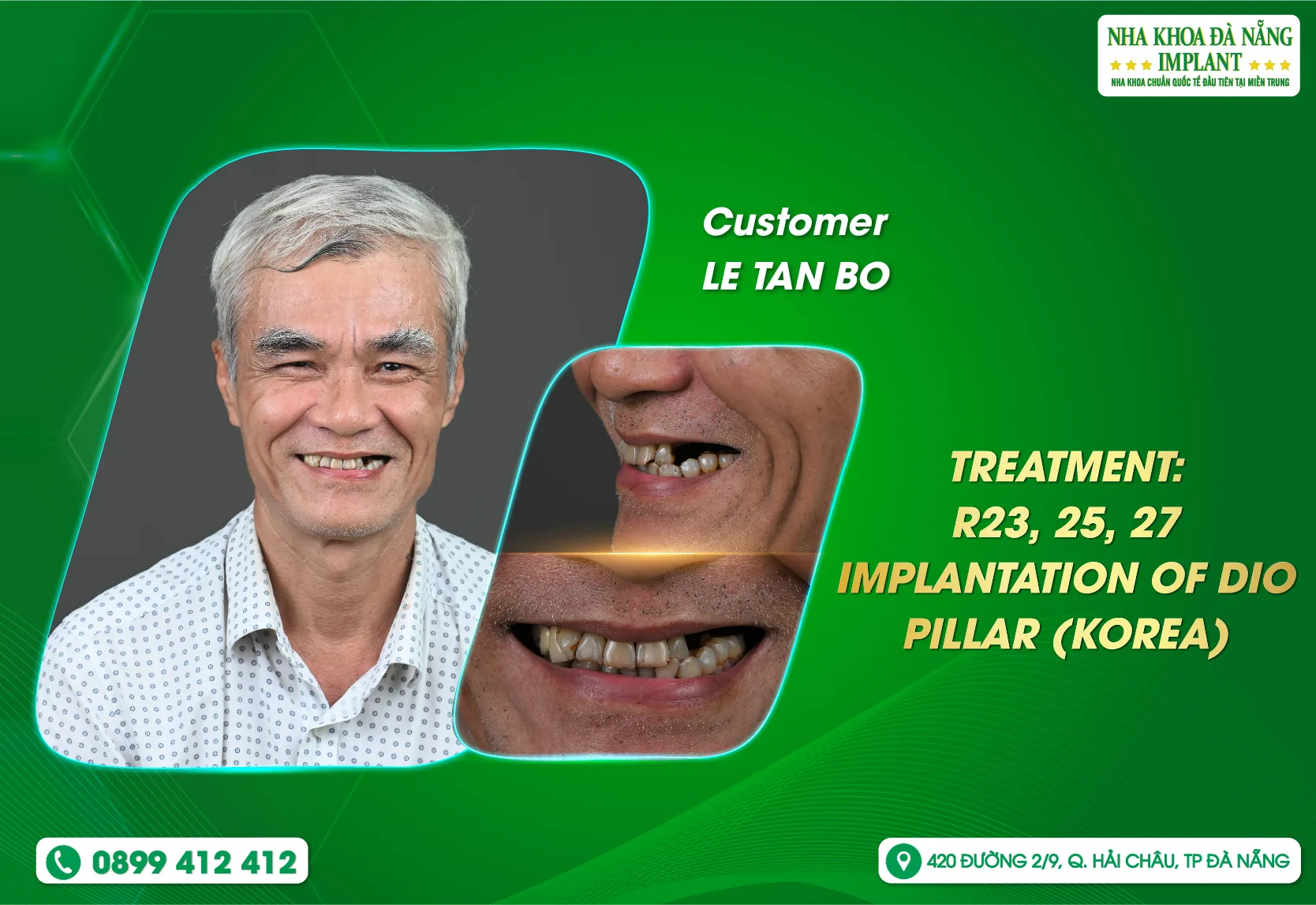 [Feedback] Find a healthy smile at Danang Implant Dental Clinic