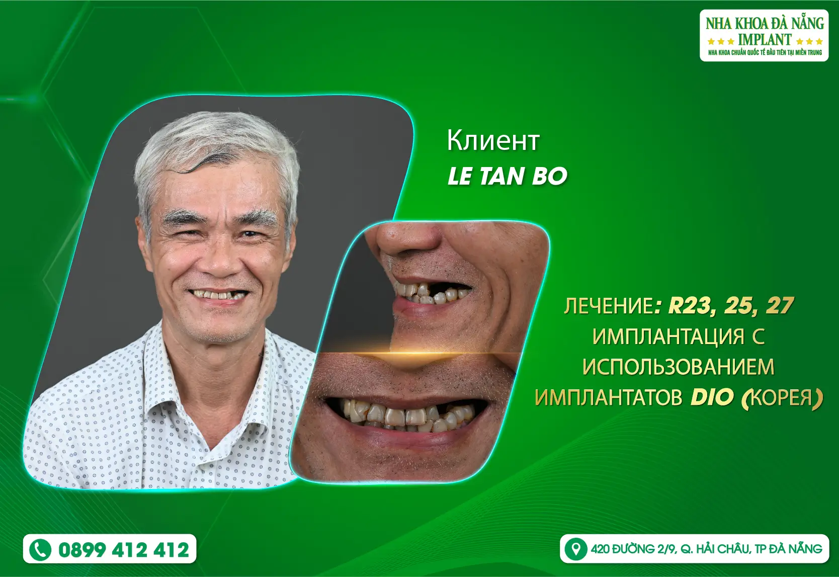 [Обратная] Возвращение здоровой улыбки в стоматологической Da Nang Implant Dental Clinic