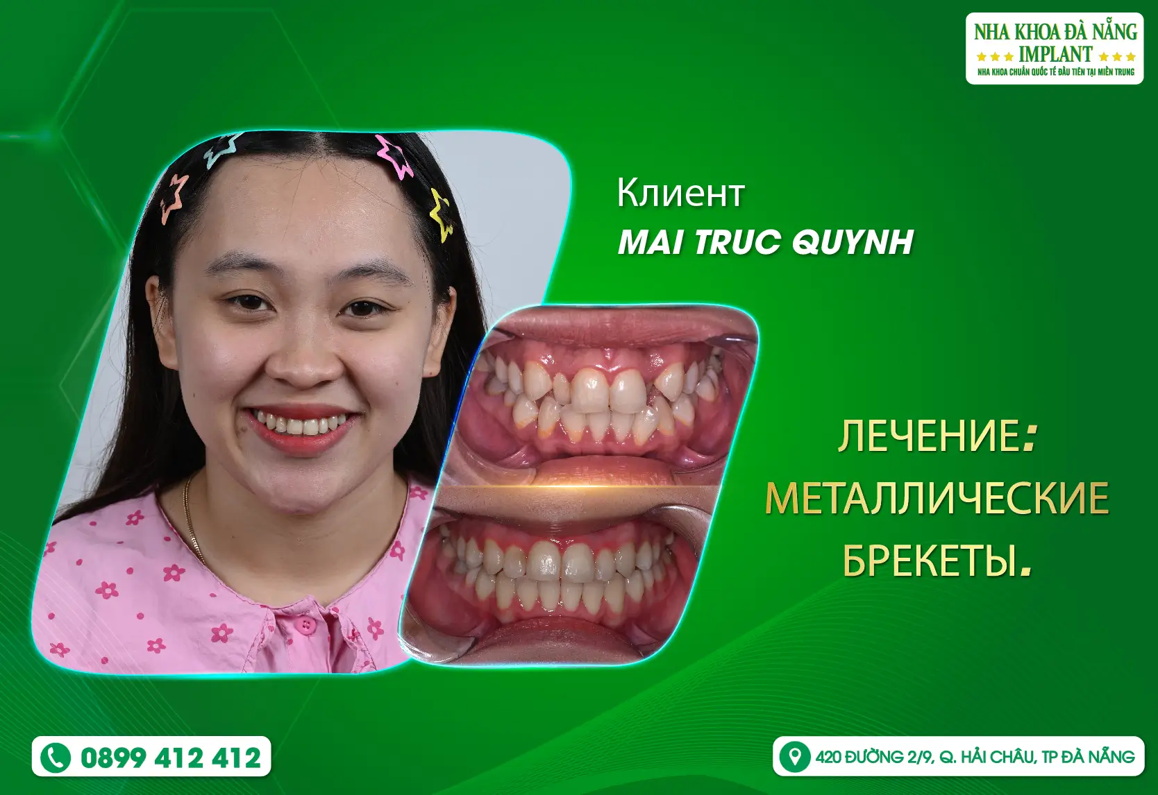 [ОТЗЫВ] Mai Truc Quynh КАК ИСПРАВЛЕНИЕ ПРИКУСА ИЗМЕНИЛО МОЮ ЖИЗНЬ