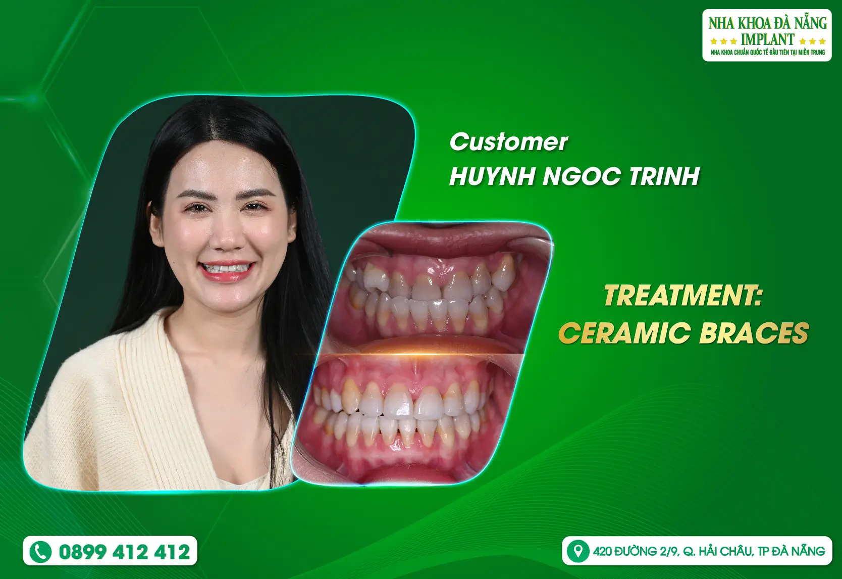 [FEEDBACK] Enhance your beauty with beautiful women thanks to braces