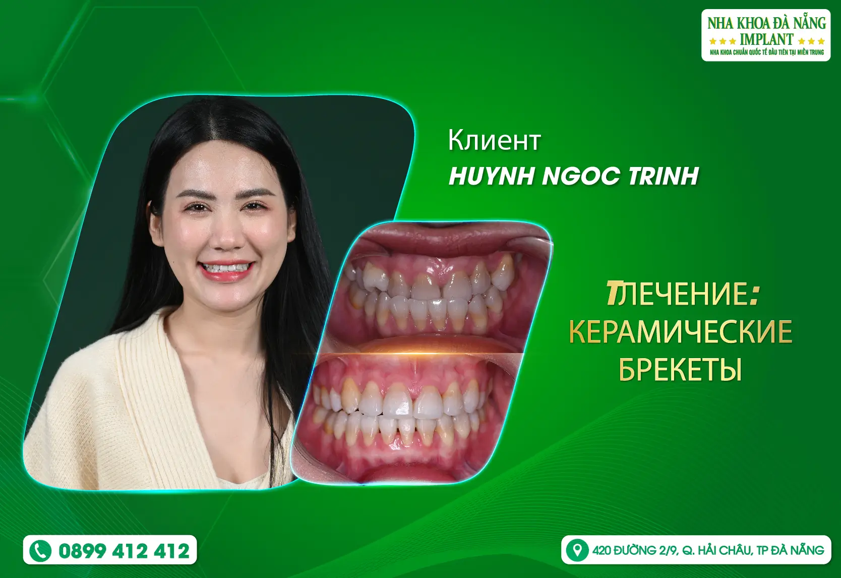 [ОТЗЫВЫ] Подчеркните свою красоту с помощью подтяжек