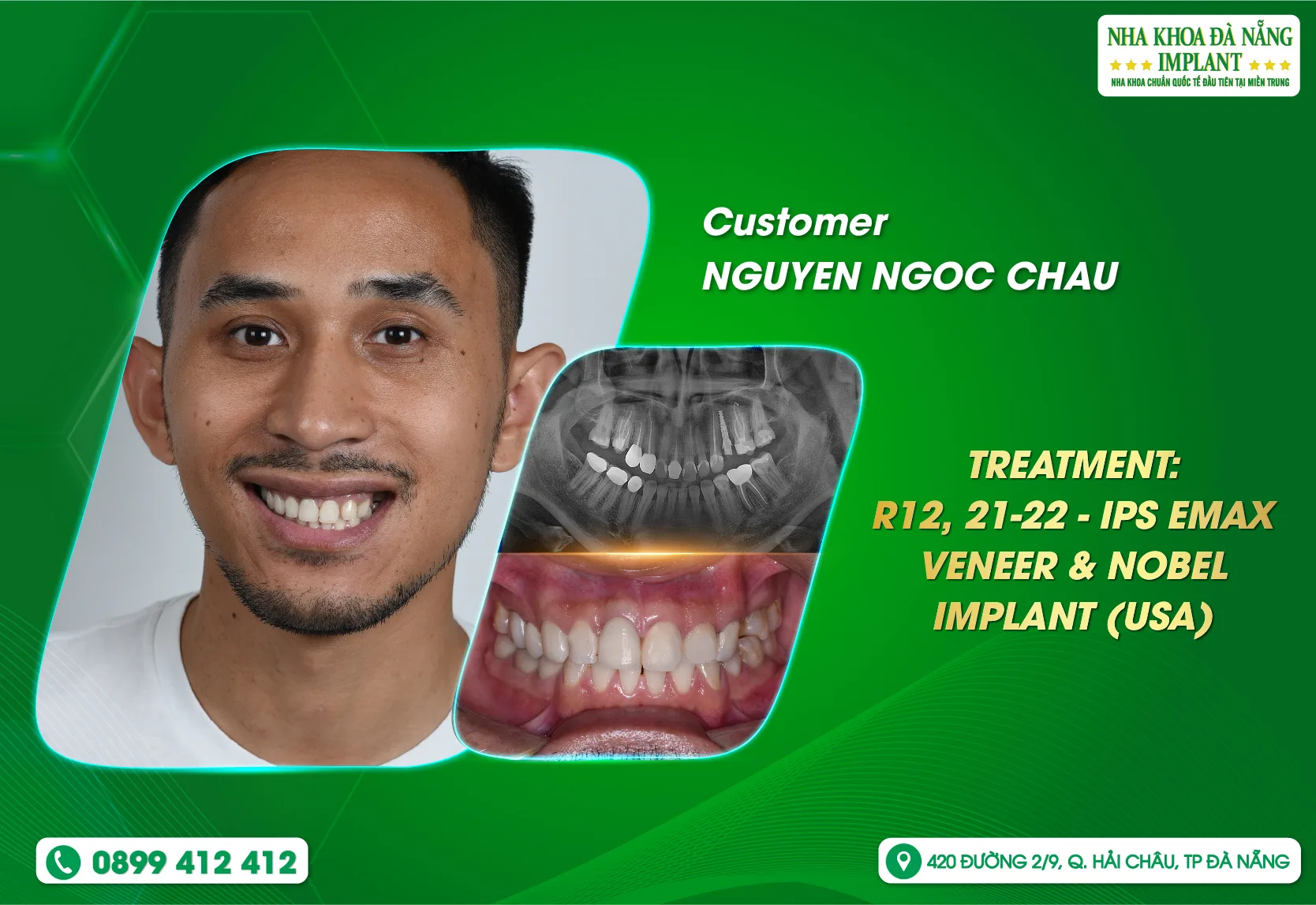 [Feedback] Revealing the reasons why overseas Vietnamese customers choose Danang Implant Dental clinic