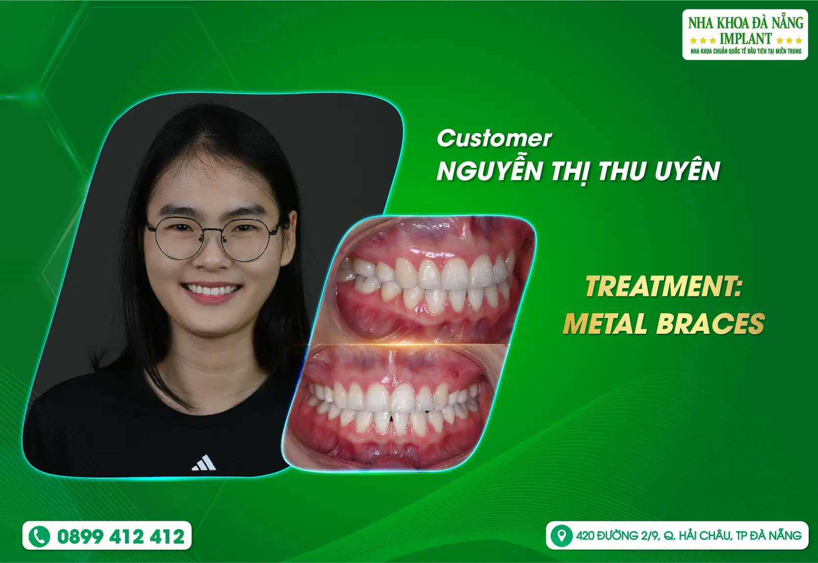 [Feedback] Creating a standard smile thanks to braces