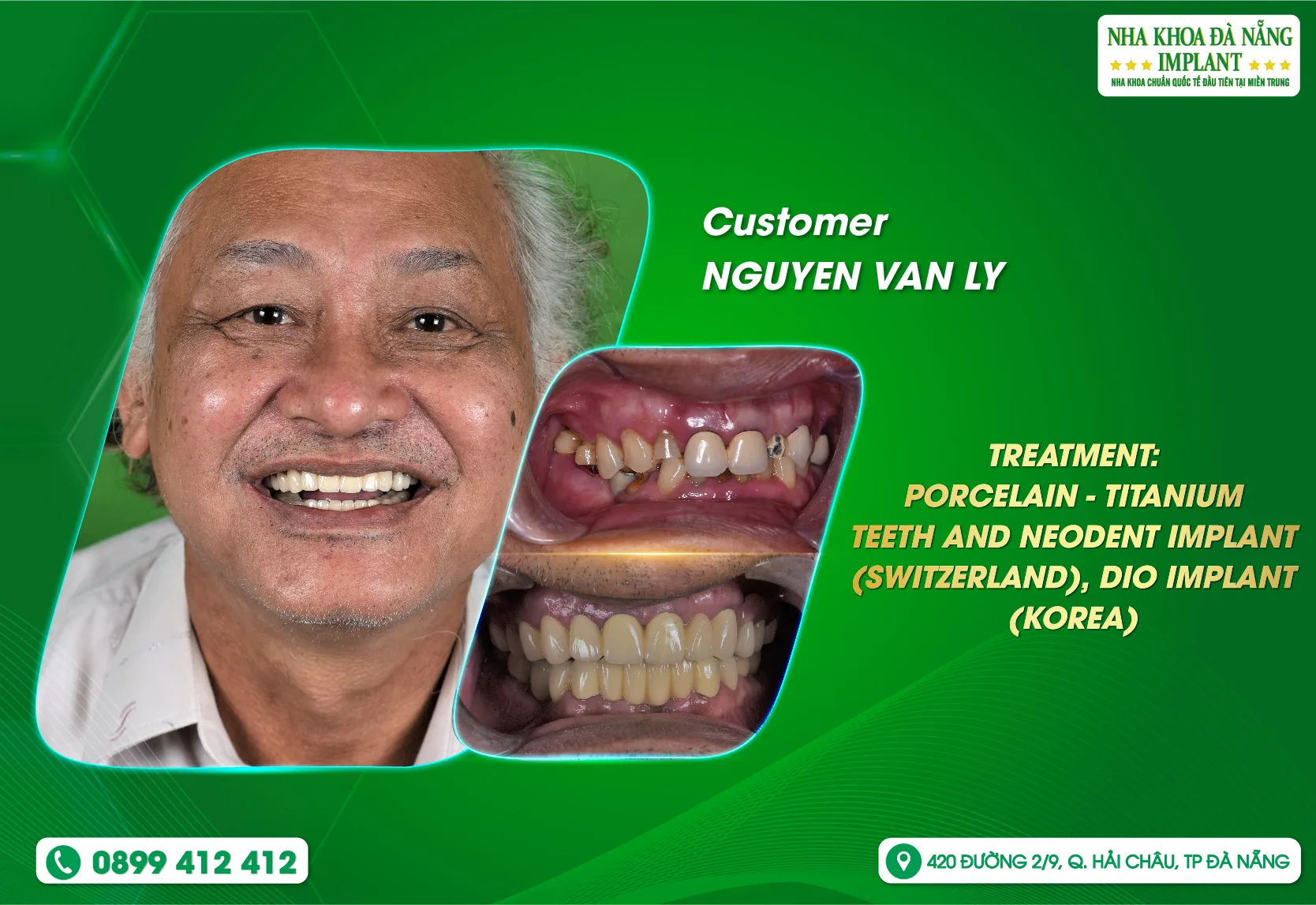 Escape the pain of losing teeth through Implant treatment