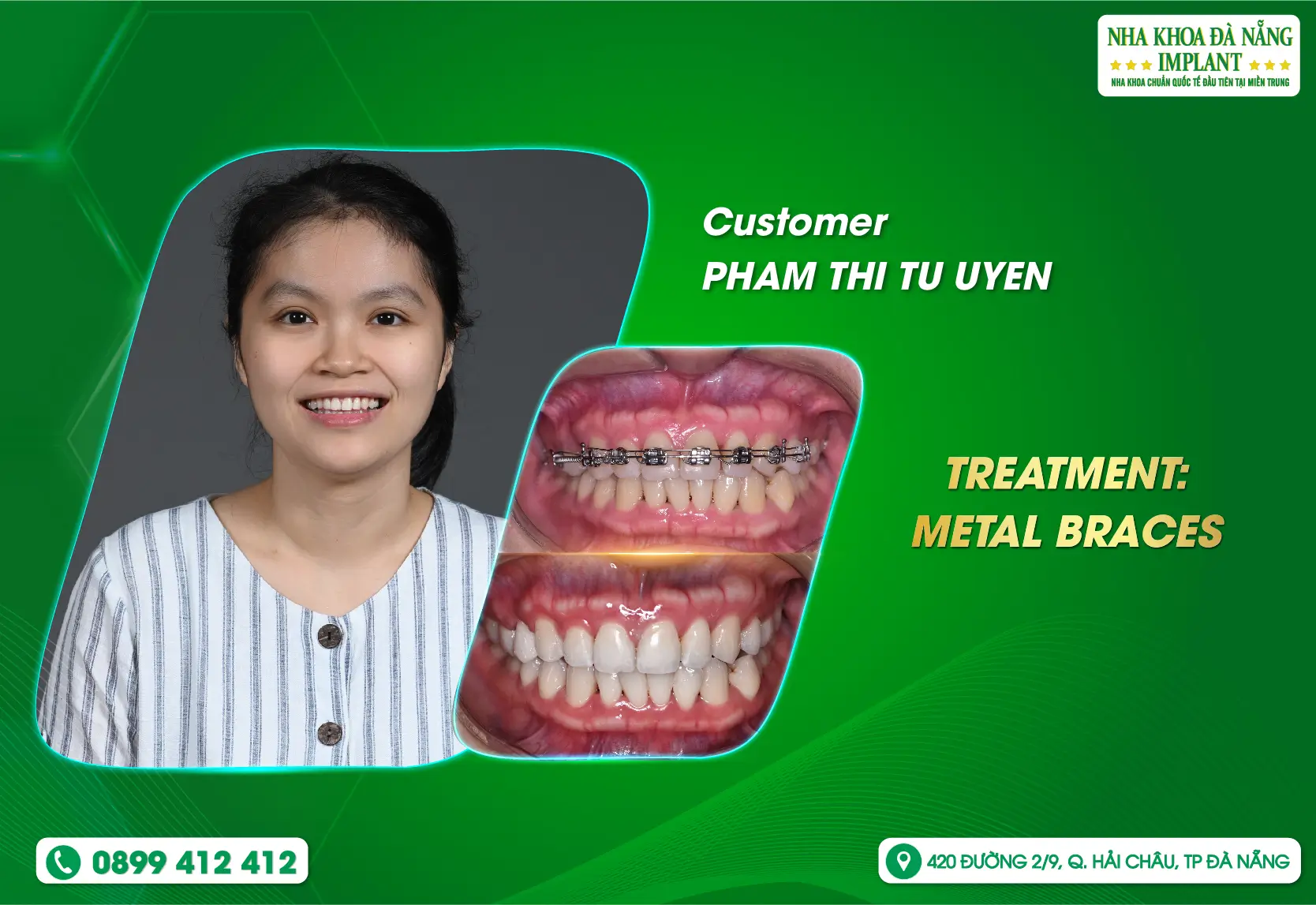 [Feedback] Choose a healthy and beautiful smile, choose Danang Implant Dental Clinic