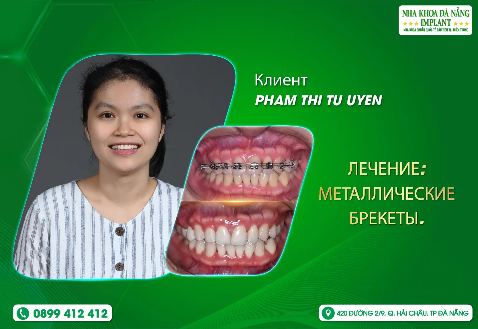 [Отзыв] Выберите красивую и здоровую улыбку с Da Nang Implant Dental Clinic