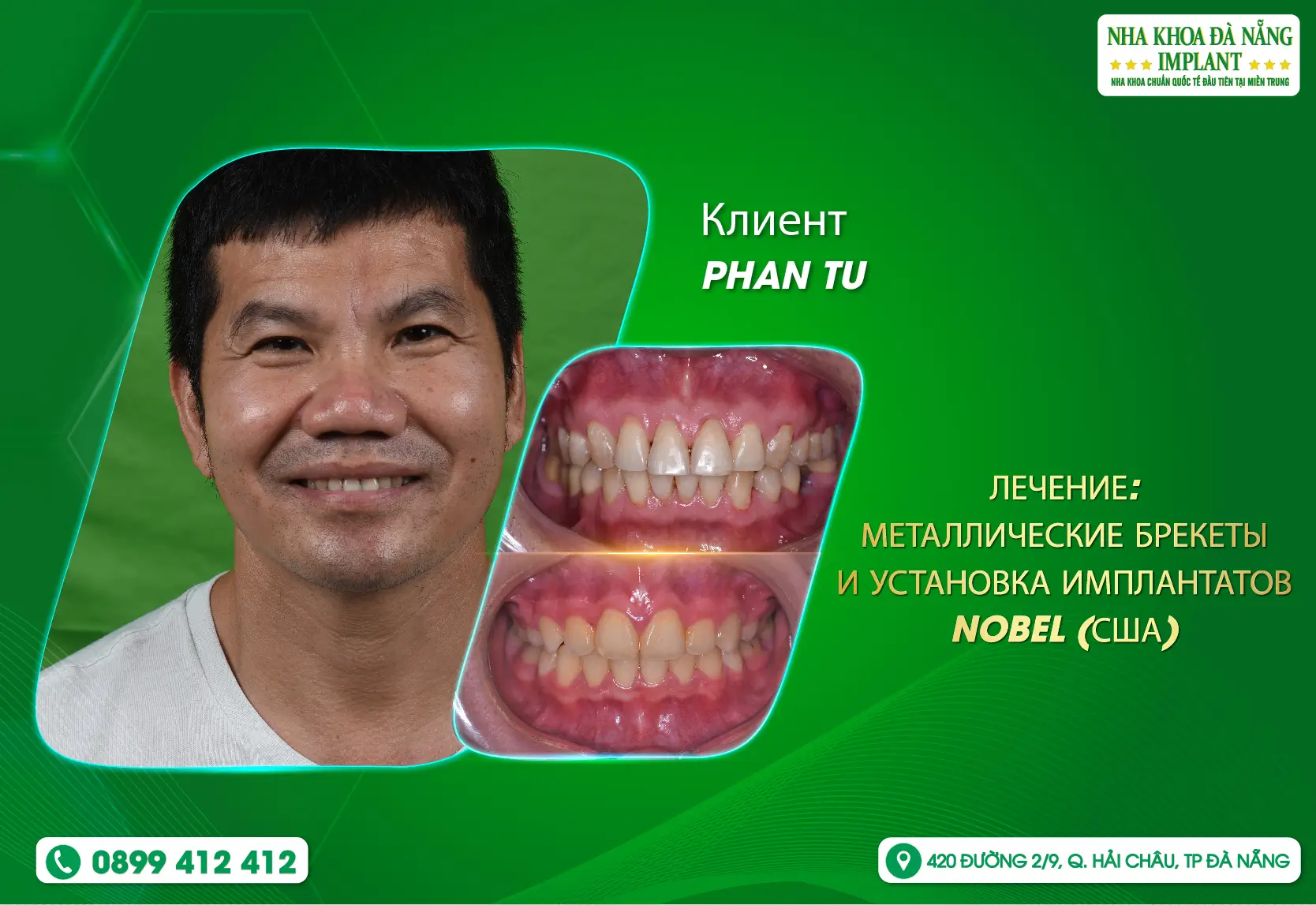 [ОТЗЫВ] Имплантация зубов несложна с Nha Khoa Đà Nẵng Implant!