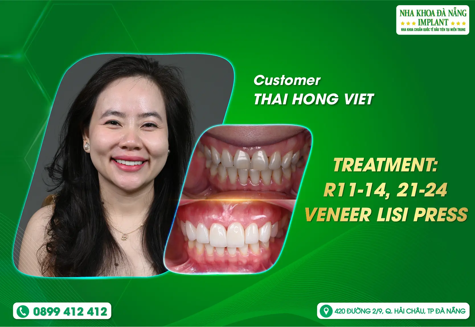Porcelain Veneers at Danang Implant Dental Clinic are NEVER WRONG choice