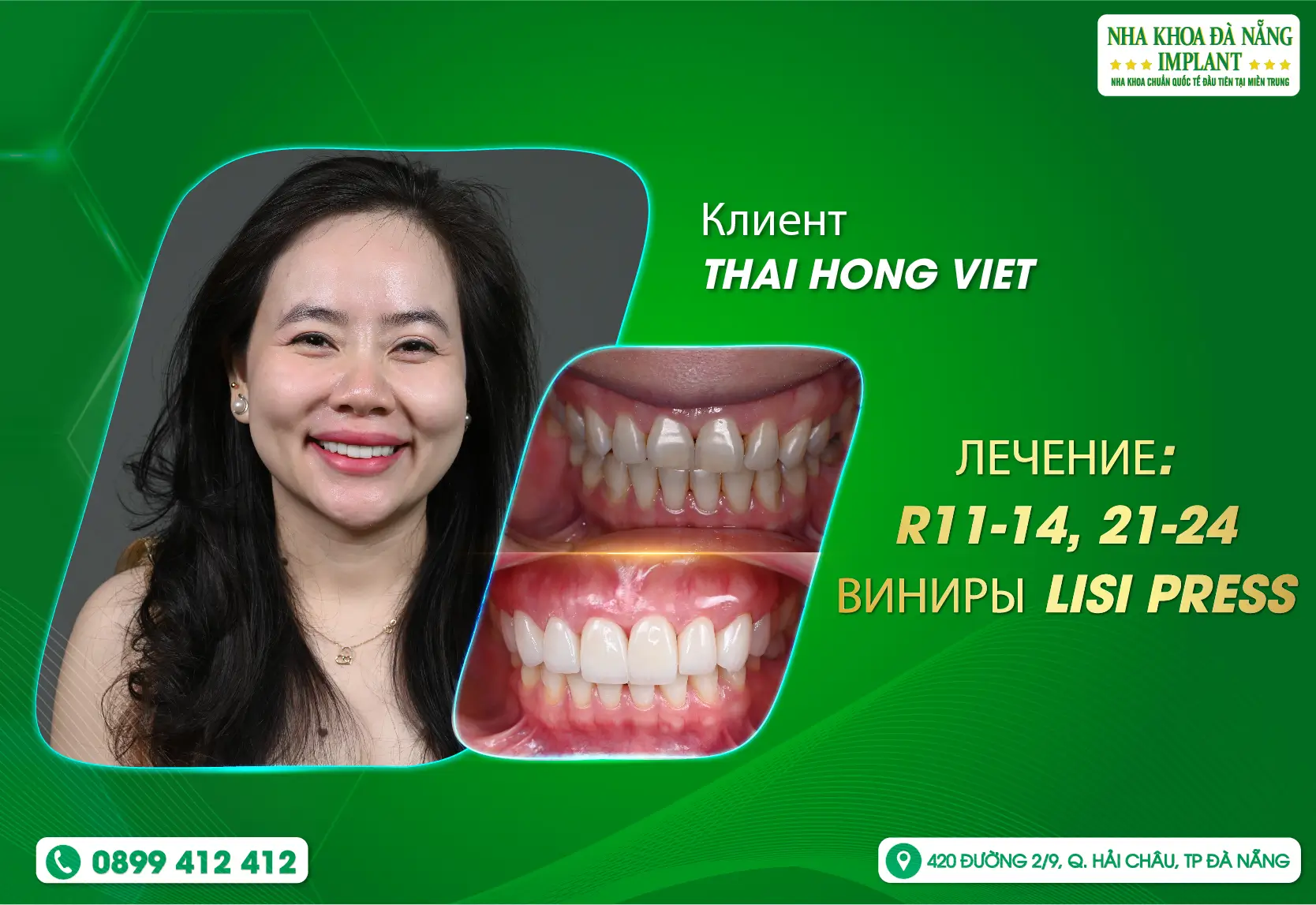 [Отзыв] Фарфоровые виниры в Danang Dental Implant — это НИКОГДА не ошибающийся выбор