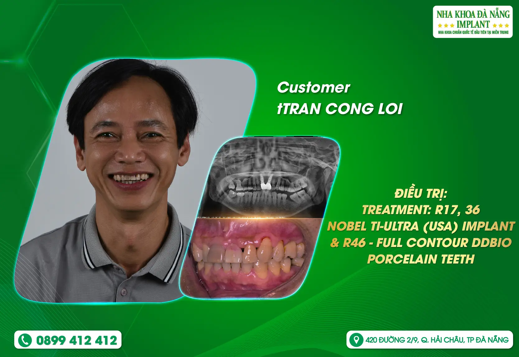 [Feedback] Implantation comprehensively solves customers' chewing and aesthetic problems