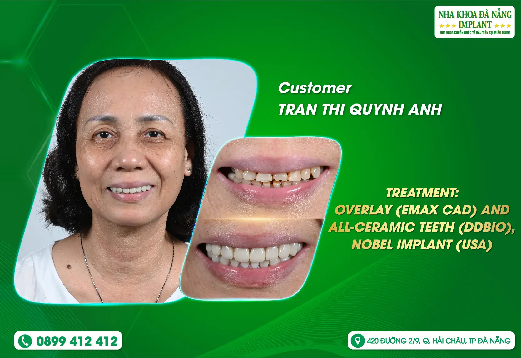 Overlay Dental Filling - The best solution to help you restore chipped teeth