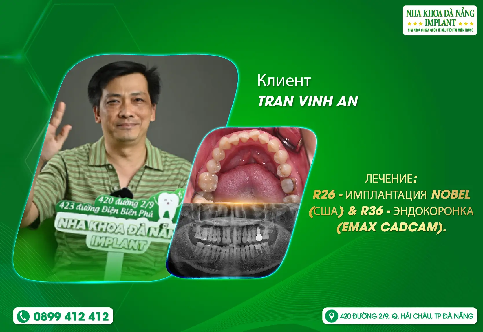 [Отзыв] Думал, что это кошмар, но в Da Nang Implant Dental Clinic я был спокоен.