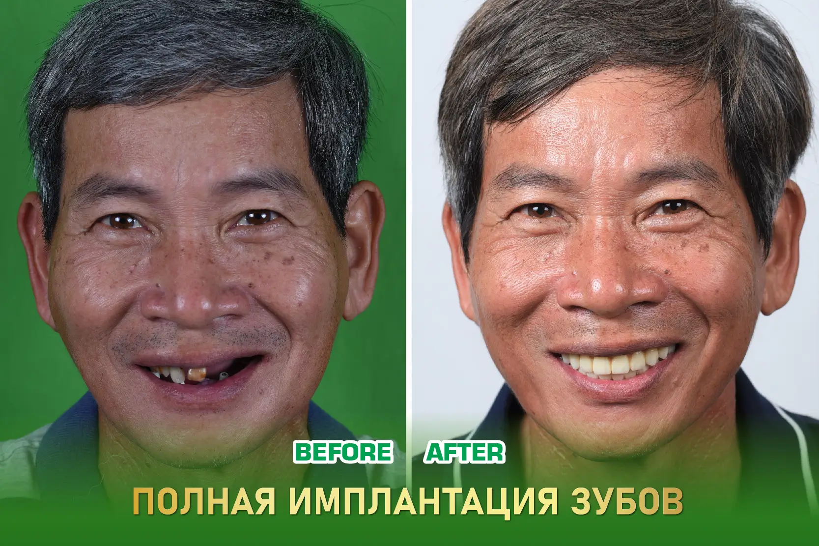 Полная имплантация челюсти