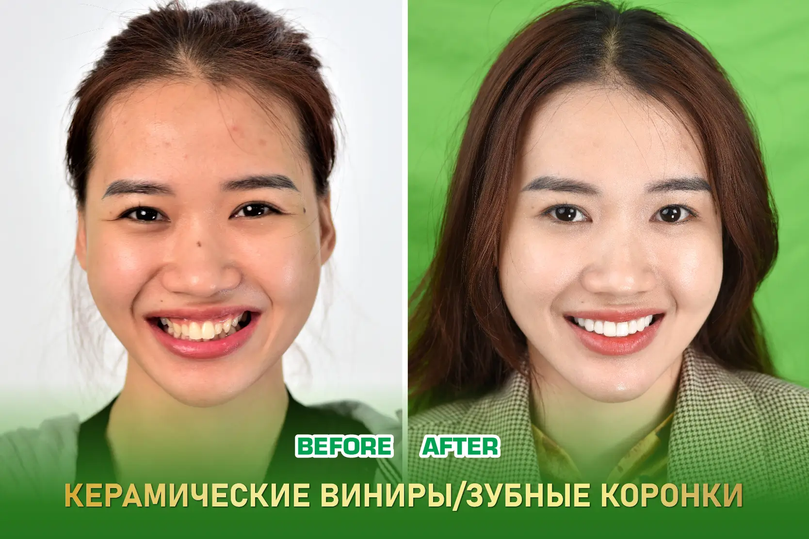 Керамическая накладка Veneer / Коронка