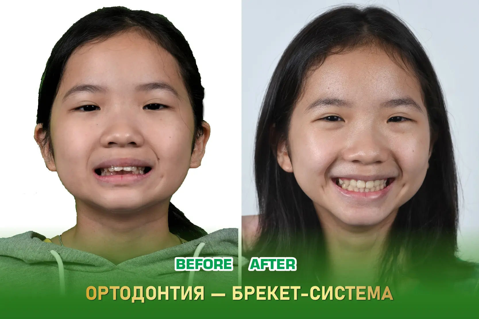 Ортодонтия – брекеты