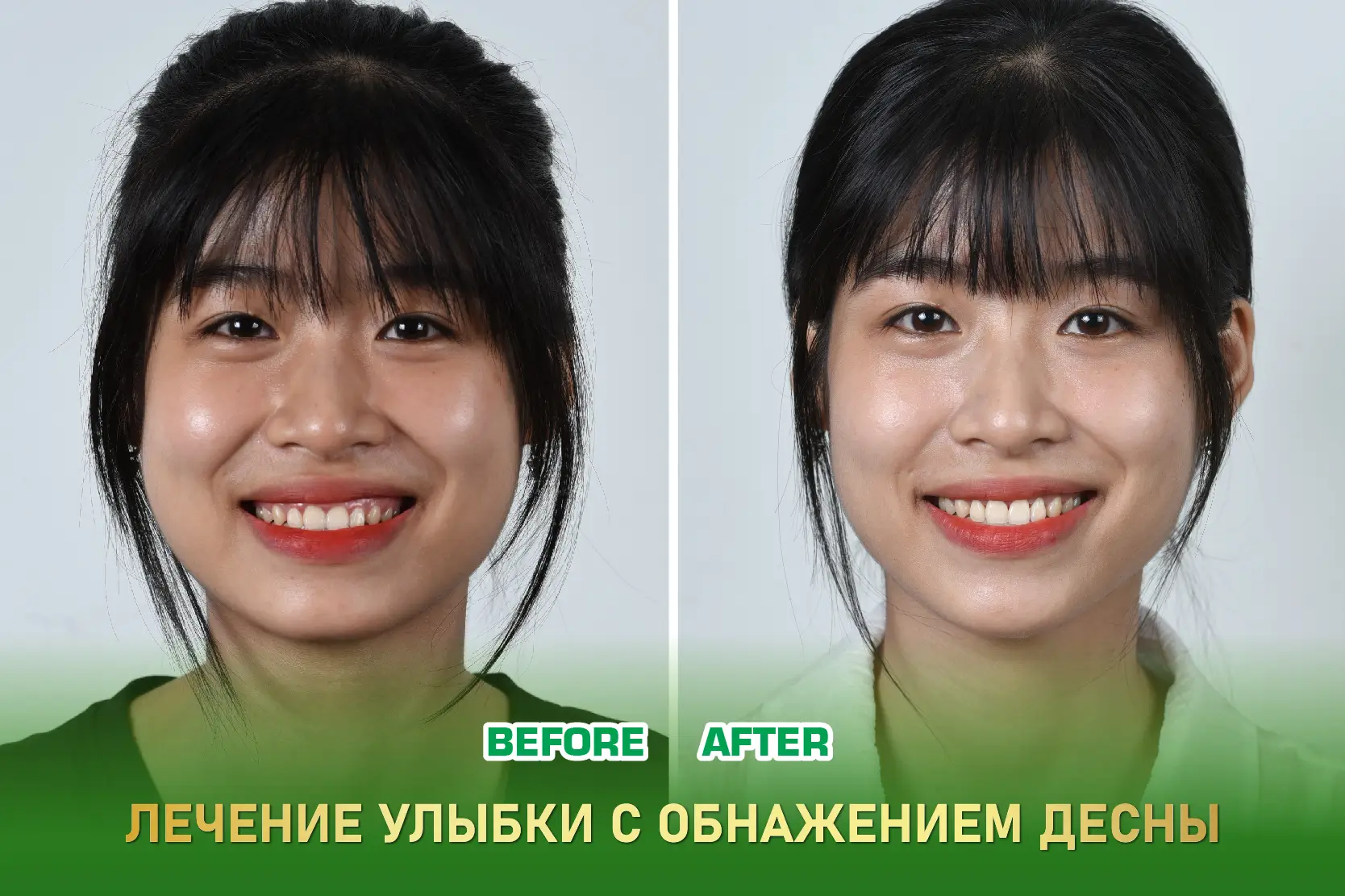 Лечение гингивэктомии при десневой улыбке