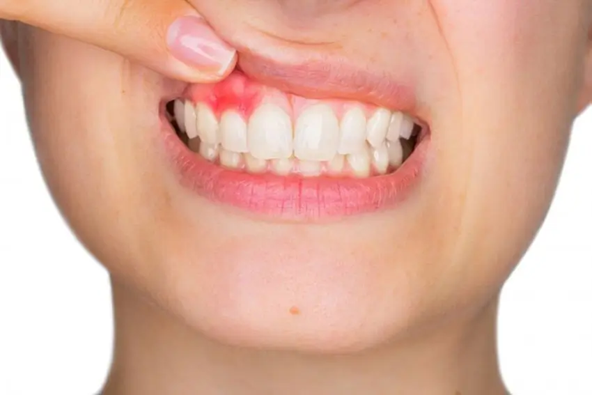 Bị ngứa chân răng: Nguyên nhân, cách điều trị và phòng ngừa
