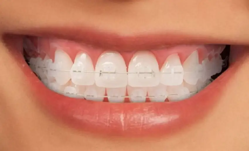 Giá niềng răng mắc cài sứ dây trong: Chi tiết và những điều cần biết