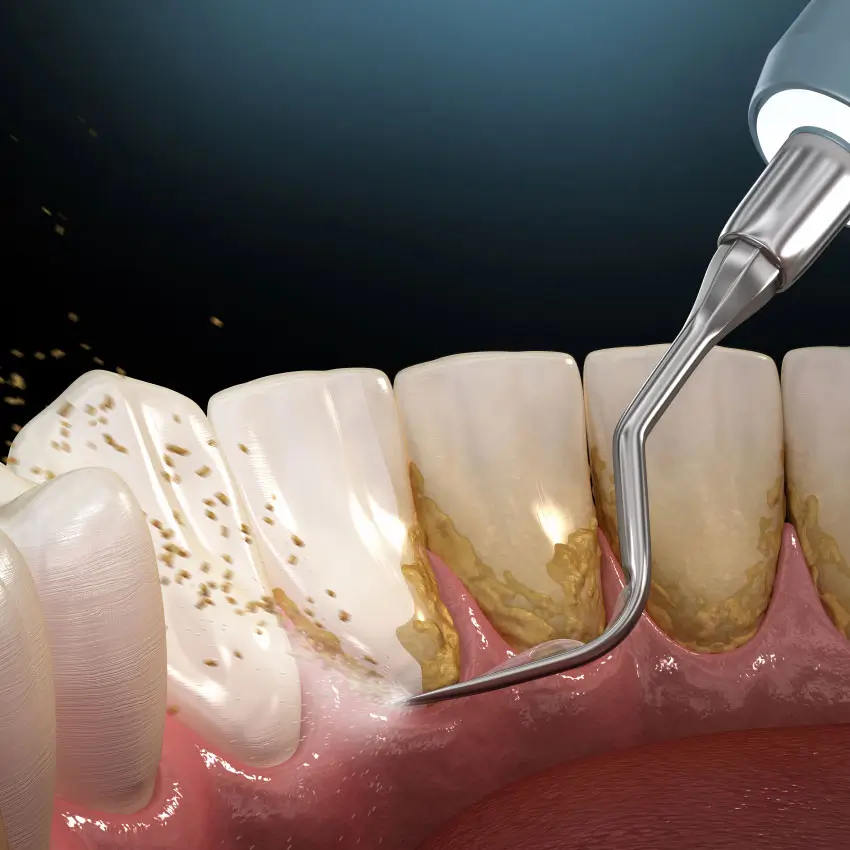 Lấy vôi răng có tốt không? Giải đáp chi tiết từ chuyên gia nha khoa
