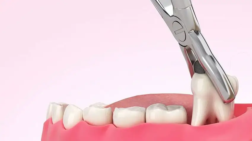 Nhổ răng khôn tốn bao nhiêu - Tìm hiểu chi tiết và địa chỉ uy tín