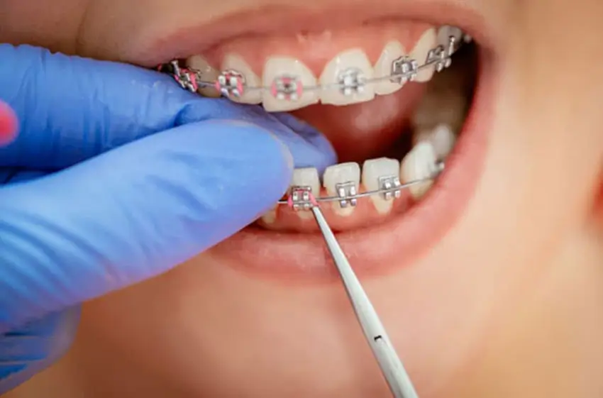 Siết răng có đau không: Giải đáp chi tiết và chuyên sâu