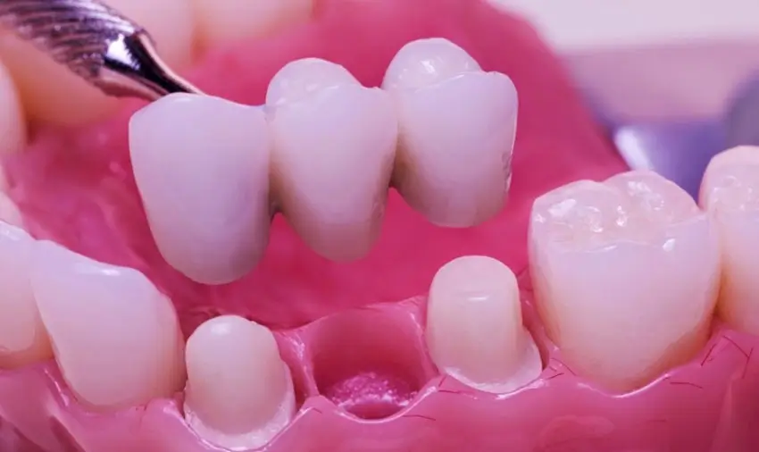 Trồng răng sứ cố định: Giải pháp phục hình răng thẩm mỹ và bền vững