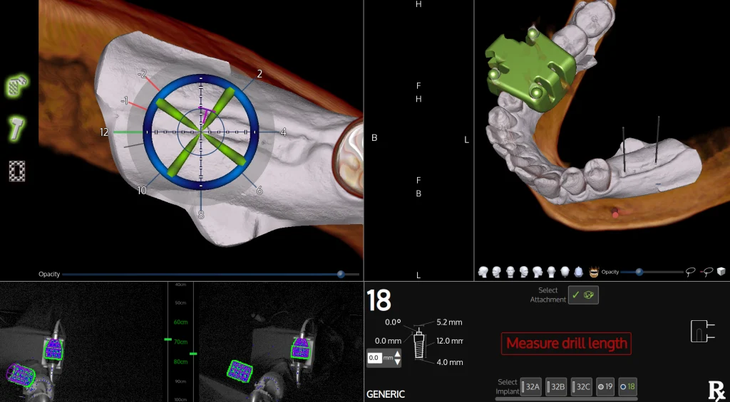 Safe Dental Implant Solution in Da Nang with X-Guide – the 'Dental GPS' | Updated 2025 Pricin