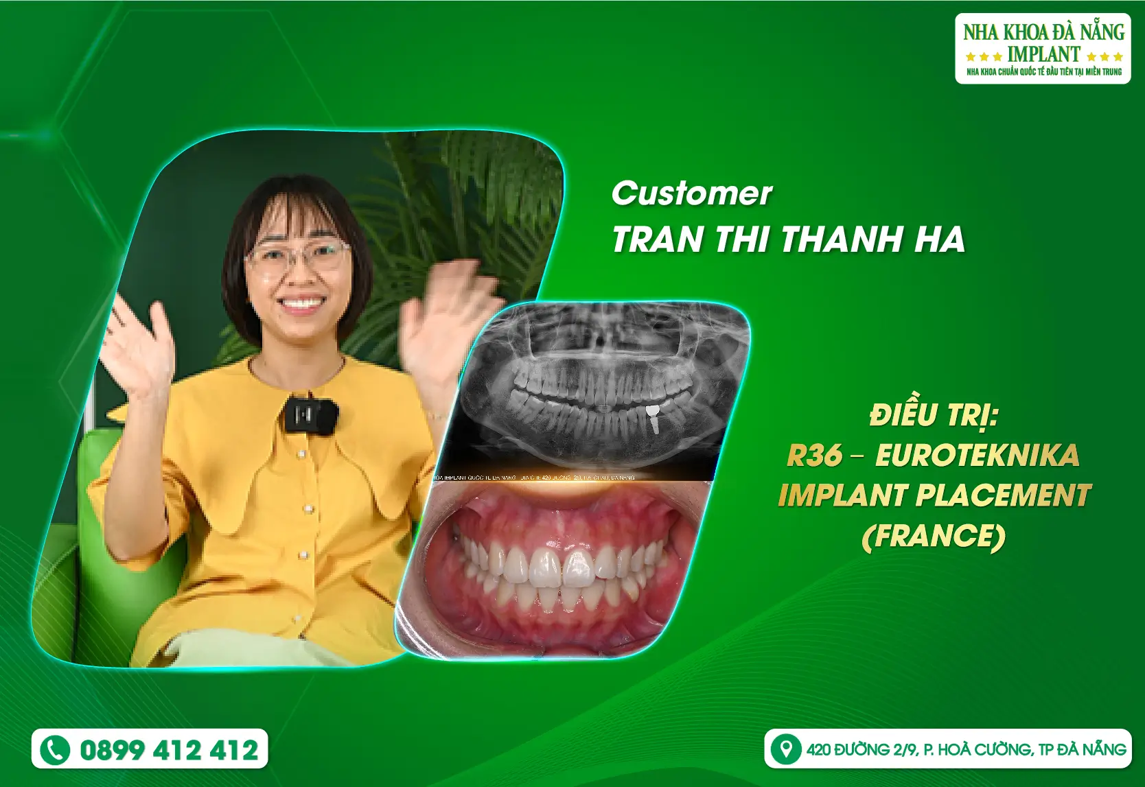 She used to worry about tooth loss, but now Ms. Thanh Hà can be completely at ease!