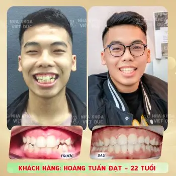 Niềng Răng Ở Đâu Tốt Tại Đà Nẵng? Top 5 Nha Khoa Được Khách Hàng Đánh Giá Cao
