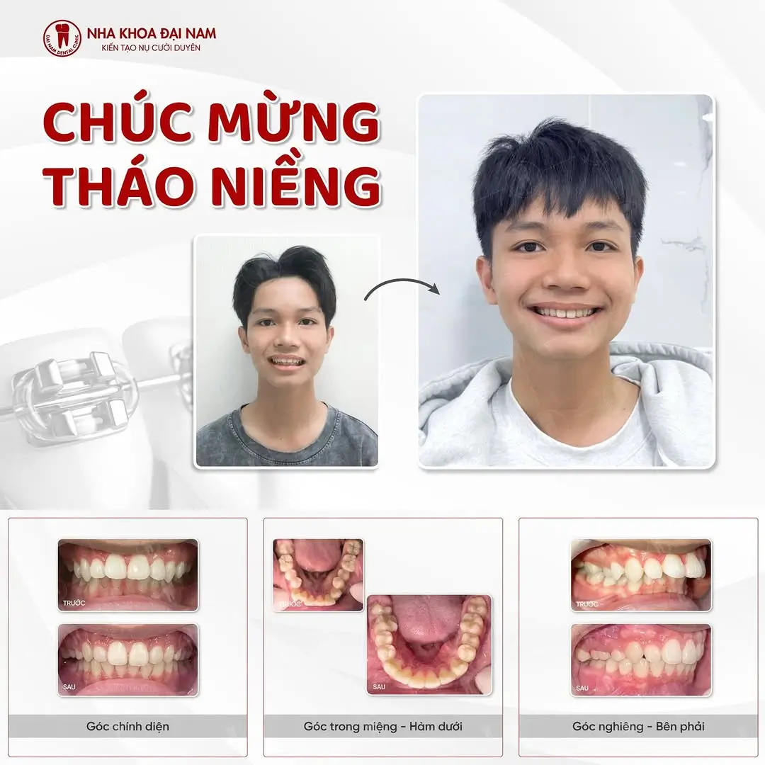 Niềng Răng Ở Đâu Tốt Tại Đà Nẵng? Top 5 Nha Khoa Được Khách Hàng Đánh Giá Cao