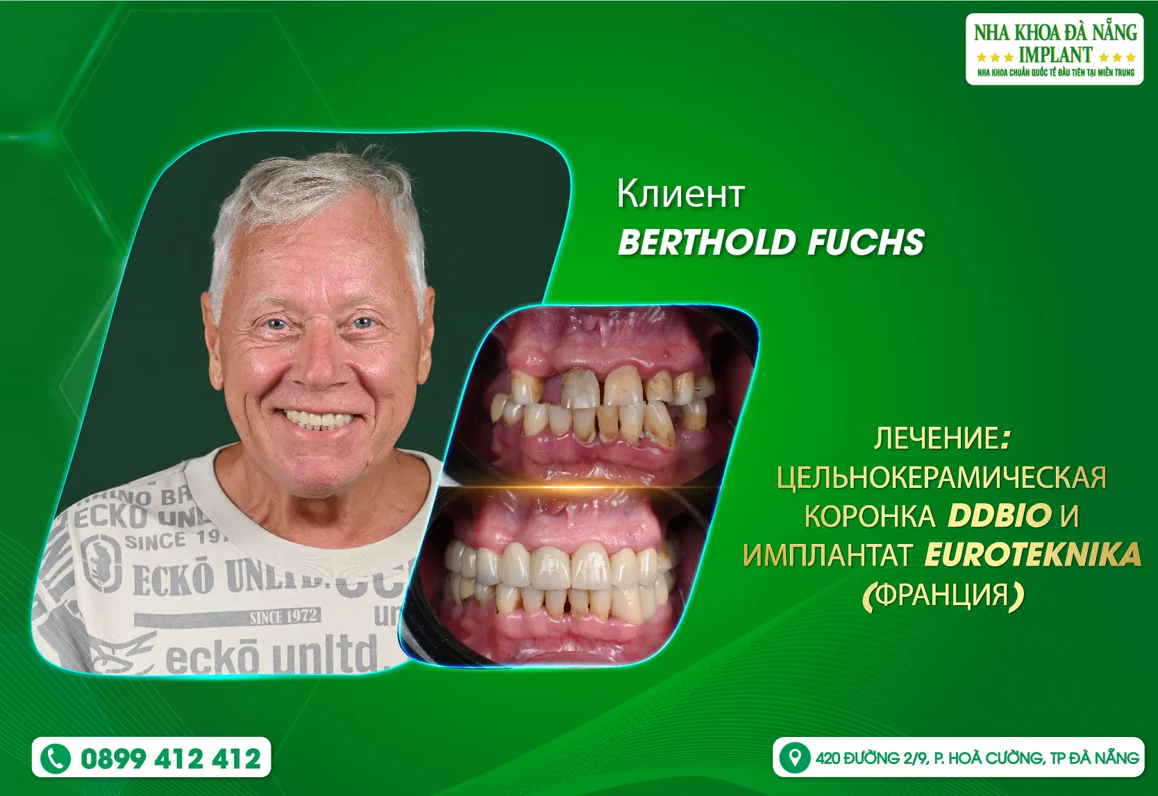 Из Германии во Вьетнам – Восстановление идеальной улыбки