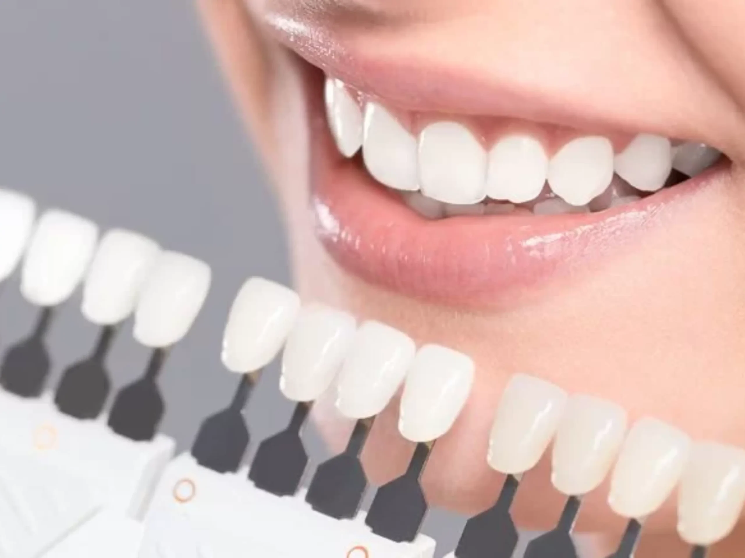 Top 5 Safe & Effective Teeth Whitening Dental Clinics in Da Nang (Updated Prices 2025)