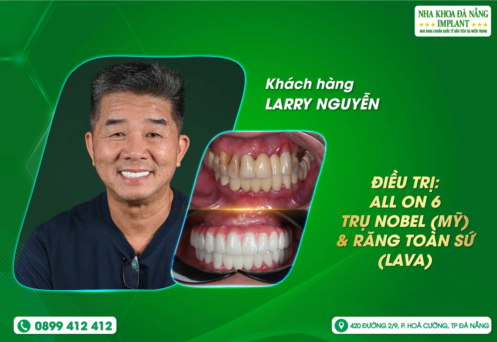 Trở về nước để hoàn thành nụ cười tự tin