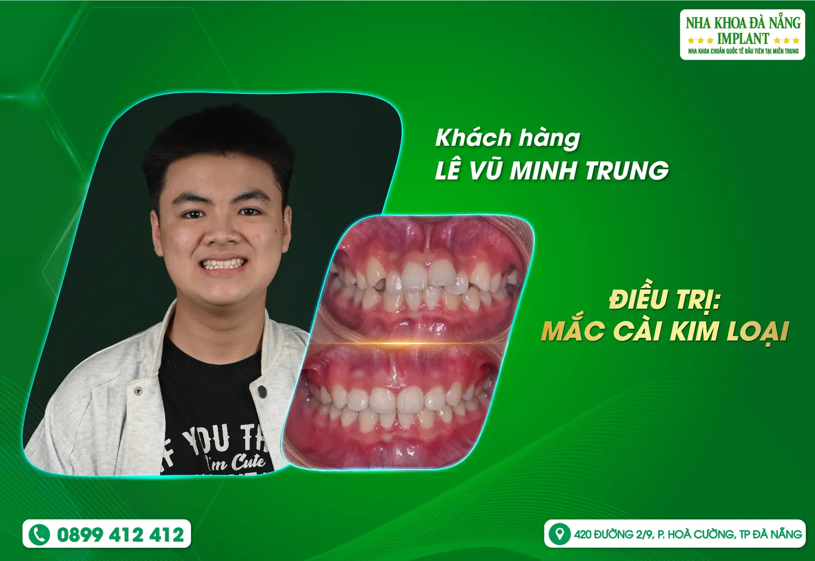 Niềng răng không chỉ thay đổi nụ cười, mà còn xóa đi những lo lắng, tự ti.