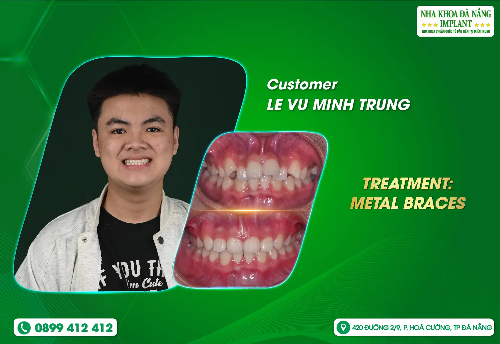 Braces not only transform your smile but also erase worries and insecurities.