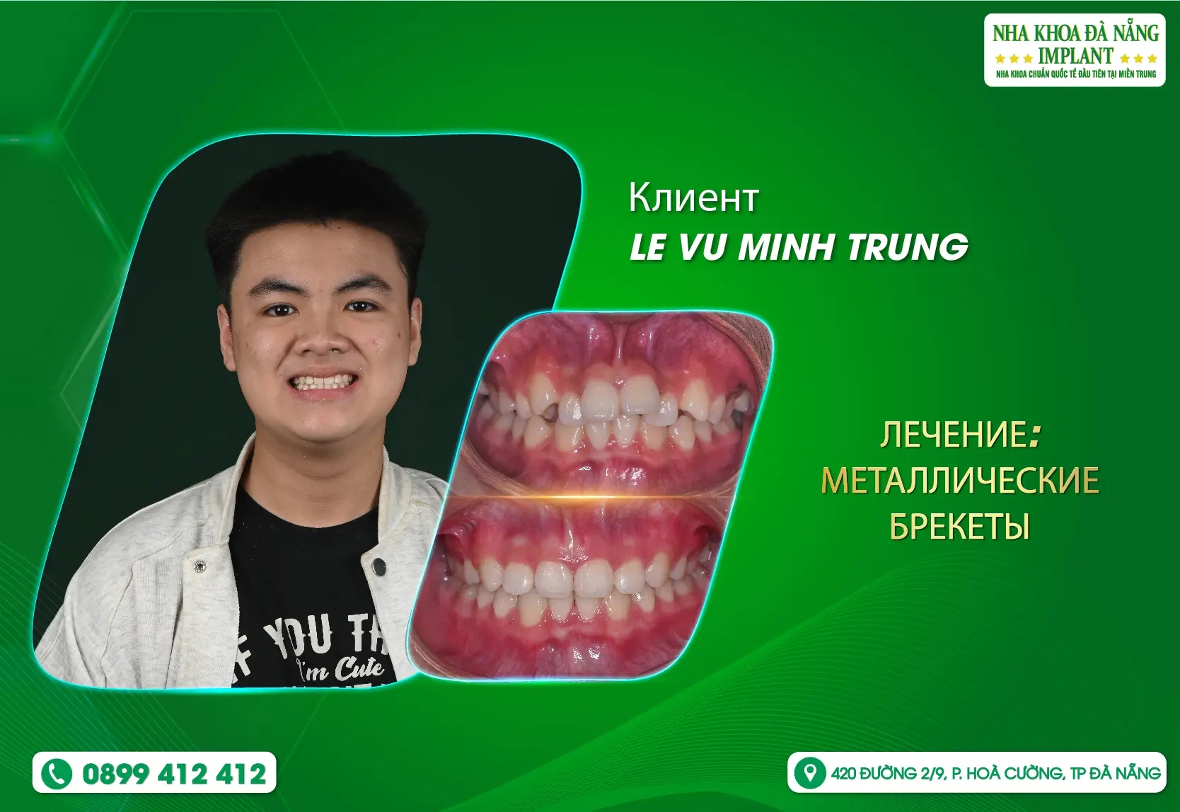 Брекеты не только меняют улыбку, но и стирают тревоги и неуверенность.