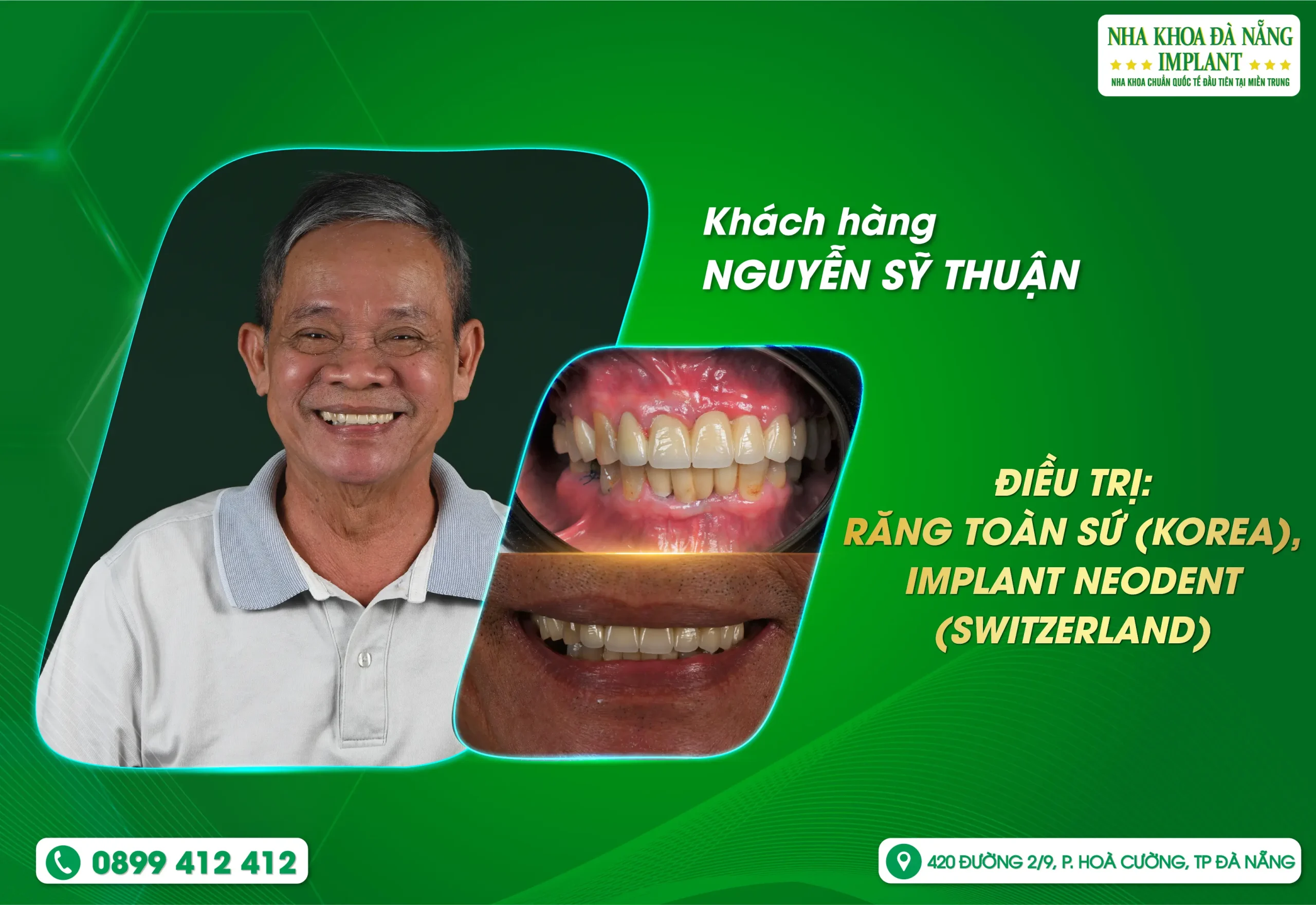 Lấy lại nụ cười - Khôi phục sự tự tin ở độ tuổi 80