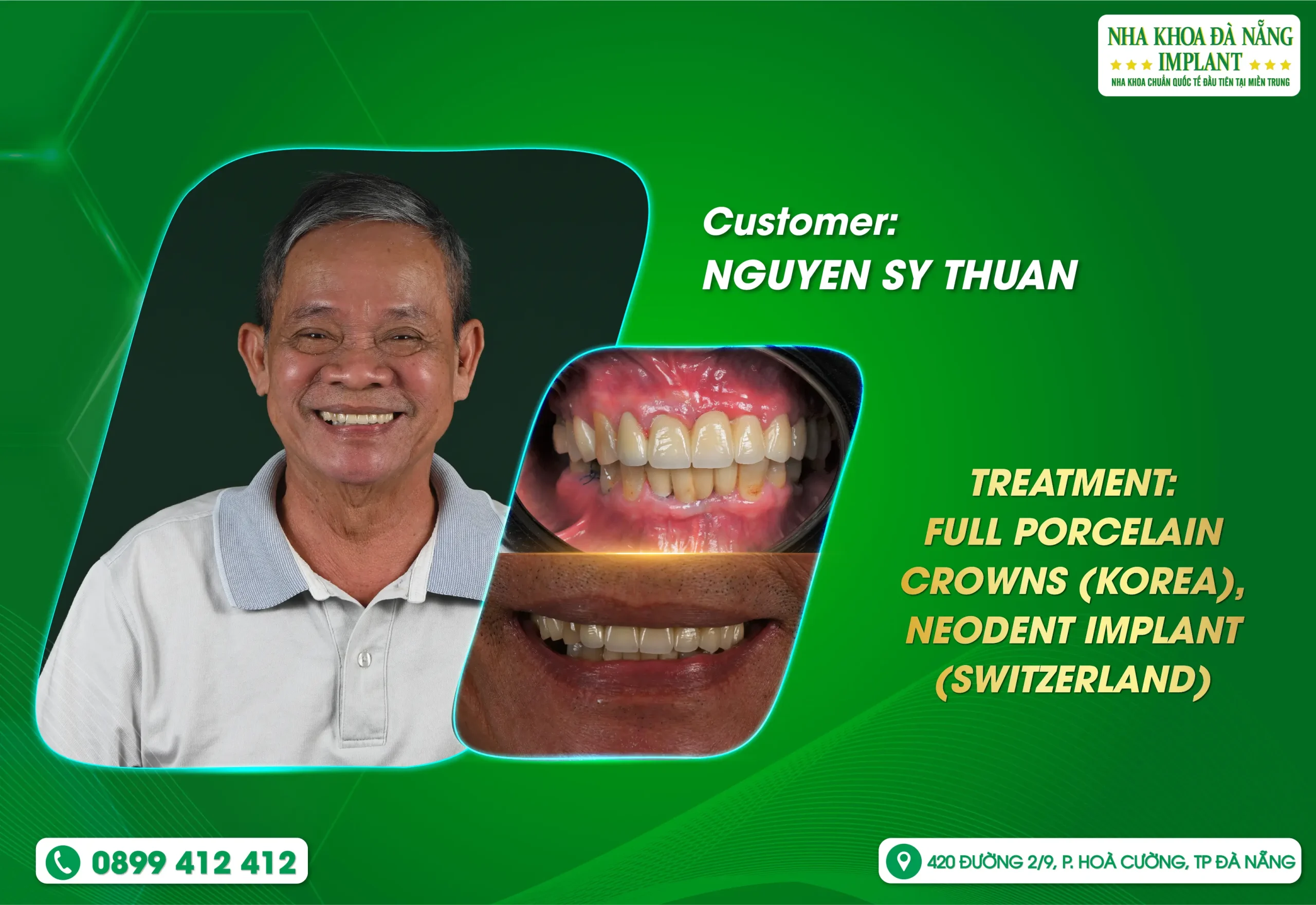 Regain Your Smile – Restore Confidence at the Age of 80