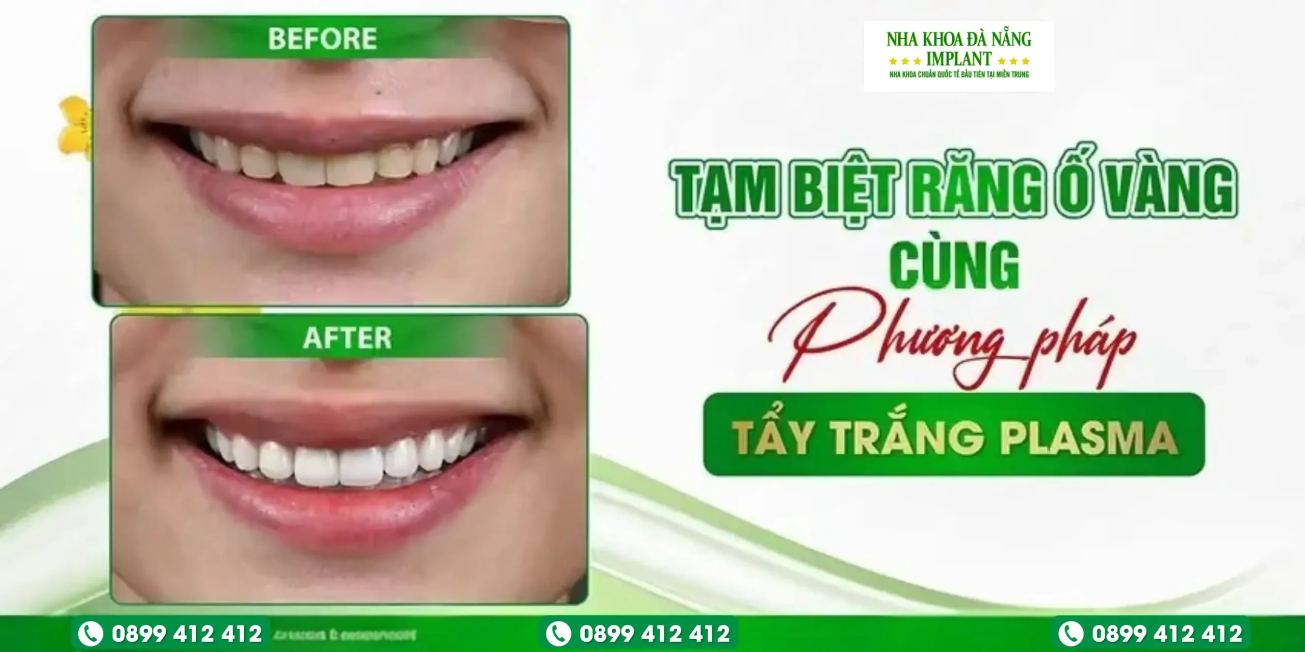 So sánh trước và sau khi tẩy trắng