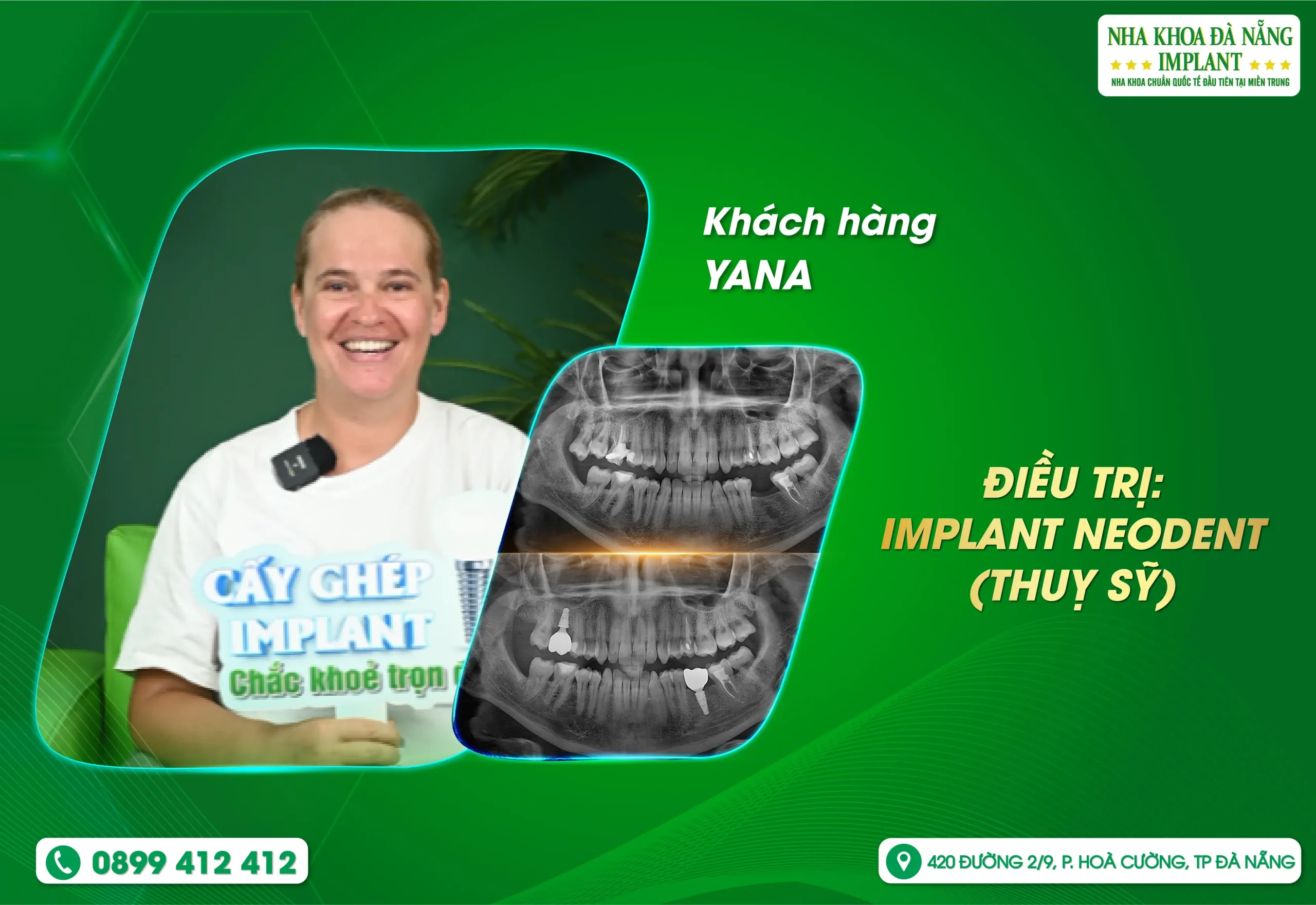 Nhanh chóng - Rõ ràng - Tận tâm: Trải nghiệm khác biệt tại Nha Khoa Đà Nẵng Implant