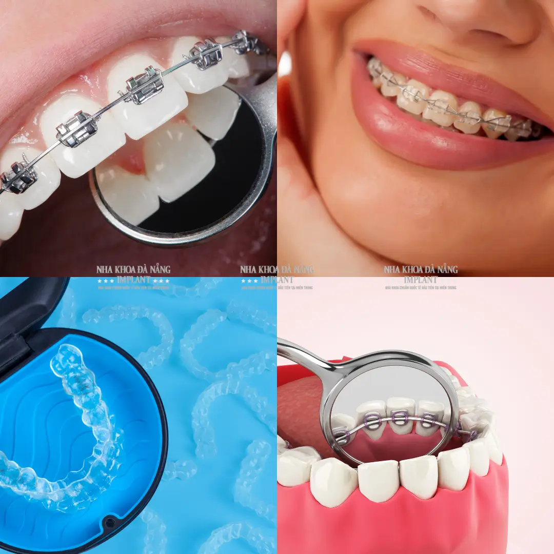 Niềng Răng Ở Đâu Tốt Tại Đà Nẵng? Top 5 Nha Khoa Được Khách Hàng Đánh Giá Cao