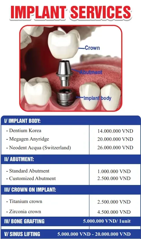 Top 5 Nha Khoa Trồng Implant Uy Tín Tại Đà Nẵng (Cập nhật 2025)