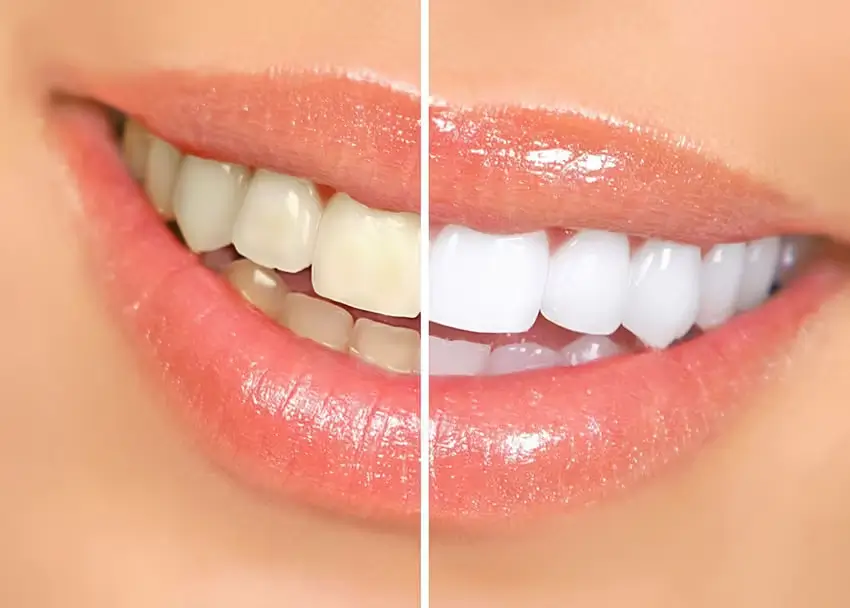 Lợi ích của việc tẩy trắng răng