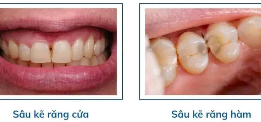 Các vị trí sâu răng kẽ