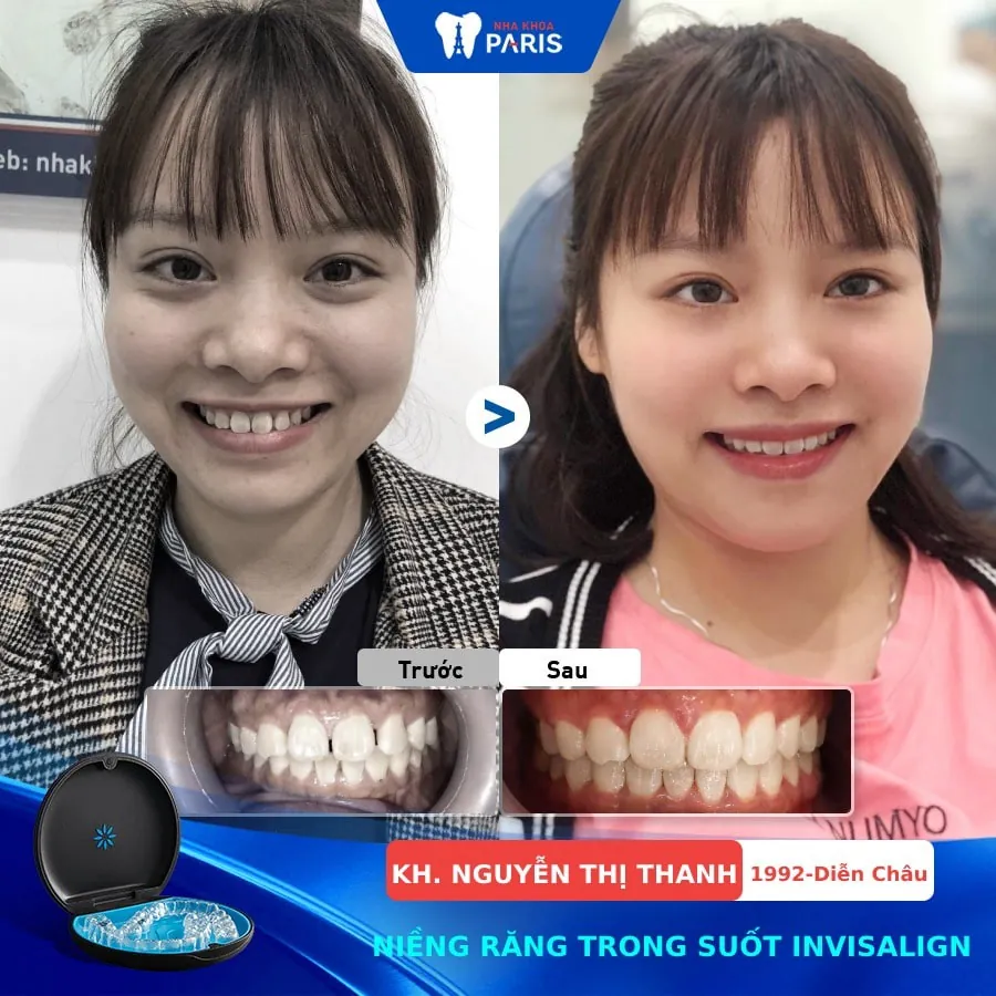 Niềng Răng Ở Đâu Tốt Tại Đà Nẵng? Top 5 Nha Khoa Được Khách Hàng Đánh Giá Cao
