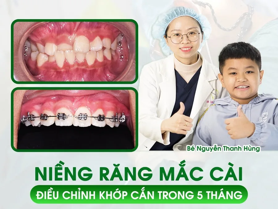 Niềng Răng Ở Đâu Tốt Tại Đà Nẵng? Top 5 Nha Khoa Được Khách Hàng Đánh Giá Cao