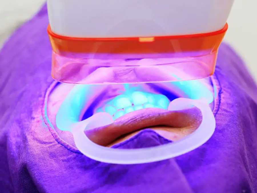 Tẩy trắng răng tại nha khoa bằng đèn plasma